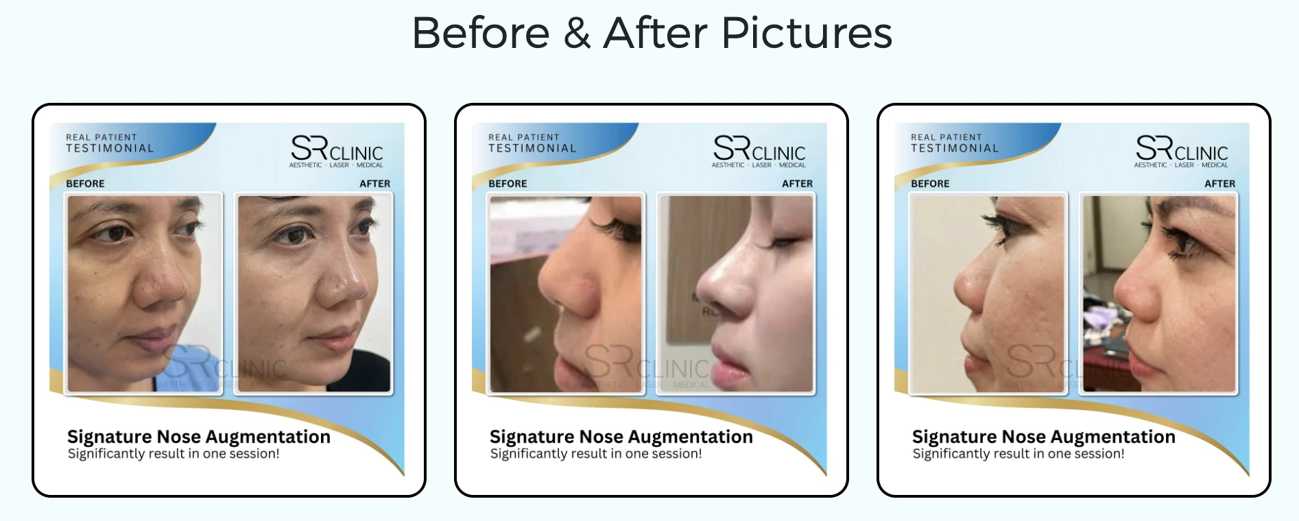 before and after nose thread lift results at SR clinic